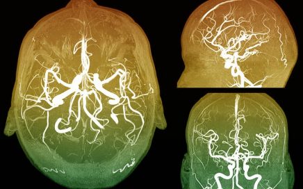Convenio Fucac-UCSF: El diseño industrial en la neurocirugía de urgencia.