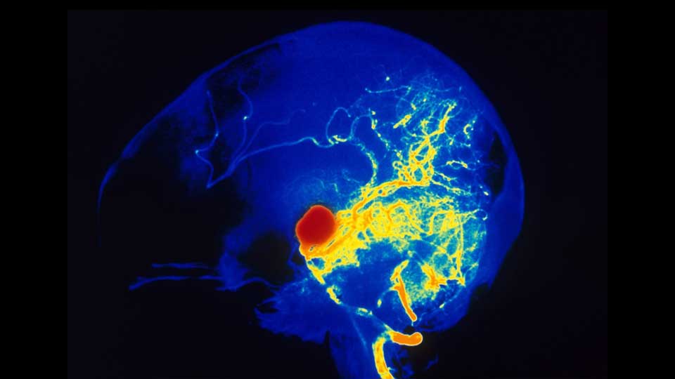 Mapa 3D por computadora de un gran aneurisma cerebral.