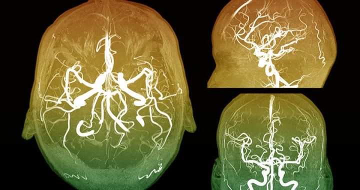 Convenio Fucac-UCSF: El diseño industrial en la neurocirugía de urgencia.