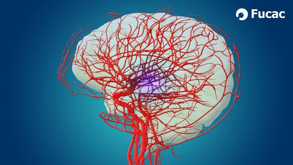 Fucac ACV: accidente cerebro vascular.