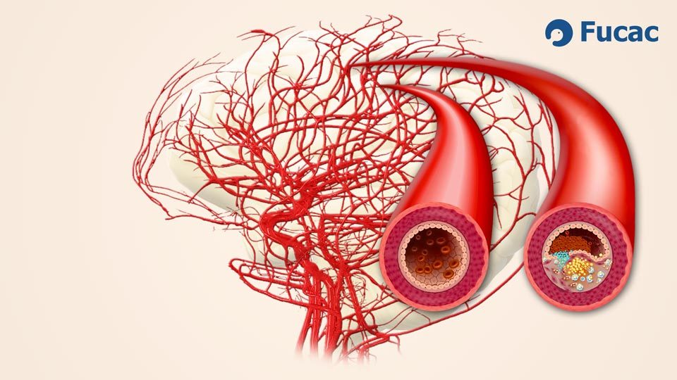 Fucac ACV: estenosis arterial, del vaso sano al vaso obstruido.