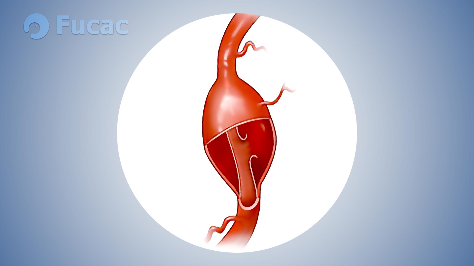 Fucac: aneurisma cerebral disecante.