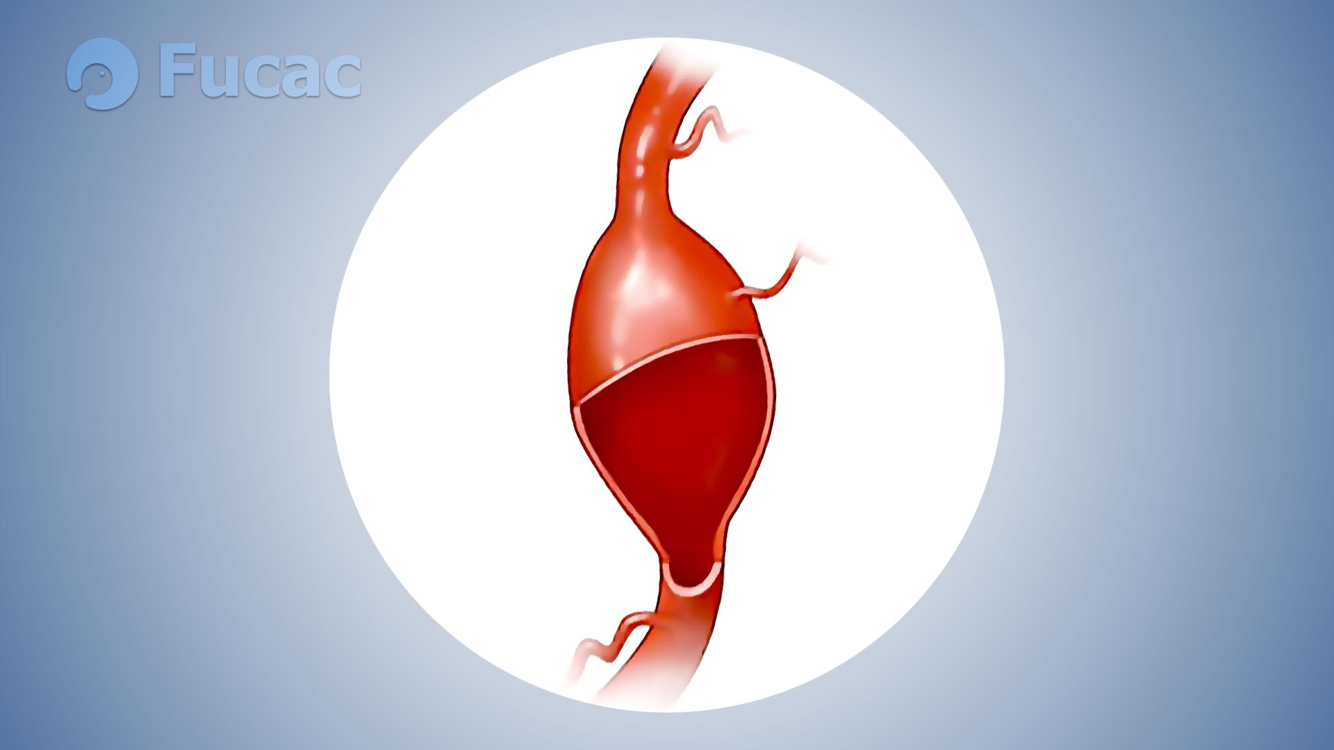 Fucac: aneurisma cerebral fusiforme.