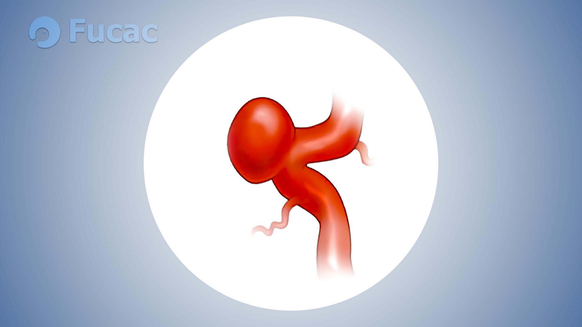 Fucac: aneurisma cerebral sacular.