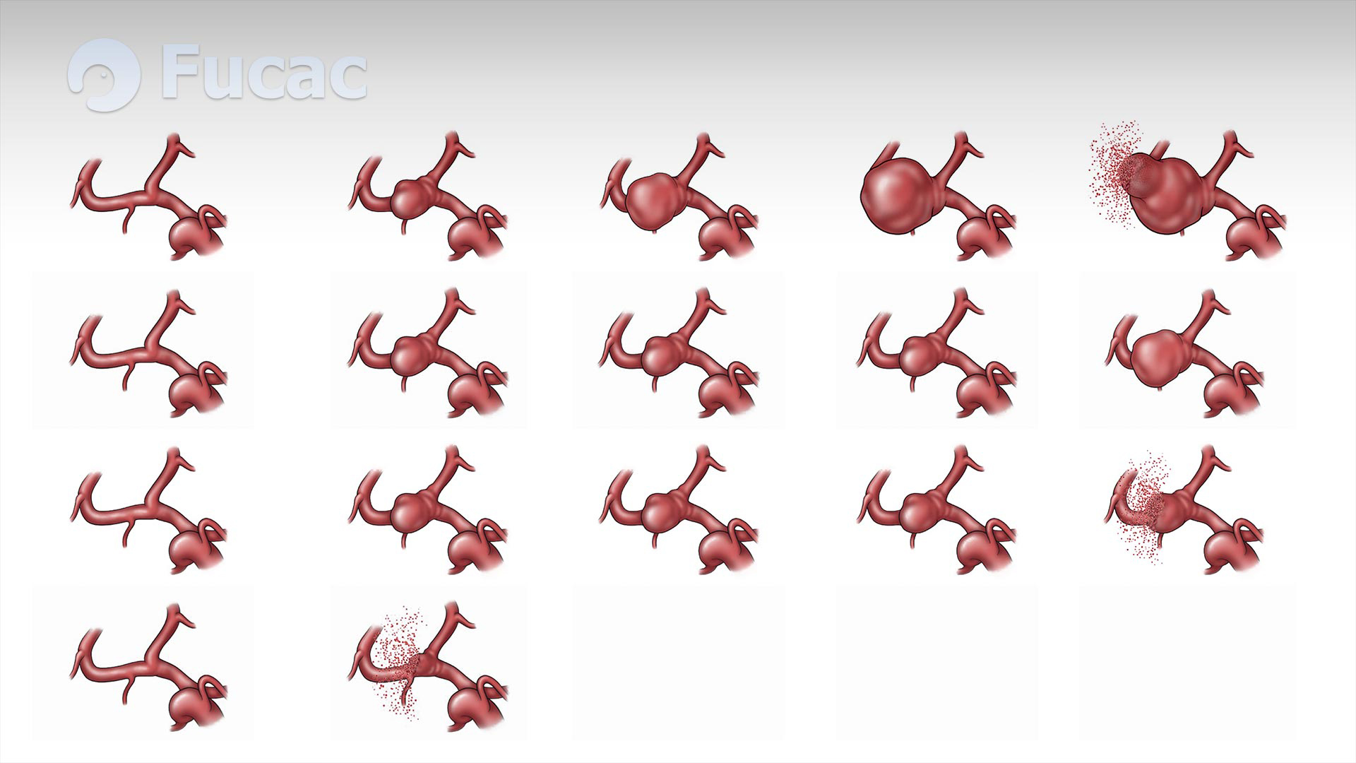 Fucac: ilustración sobre tamaños y evolución de aneurismas cerebrales.